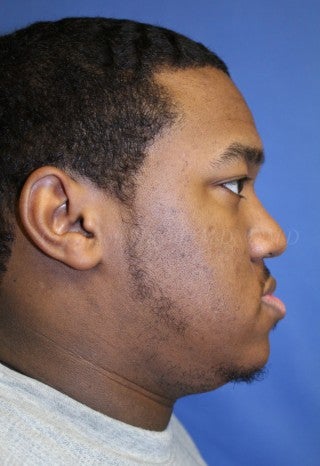 A young man with large underbite treated with Jaw Surgery (Orthognathic Surgery) 783712