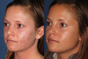 Before and After PDT before 1033841
