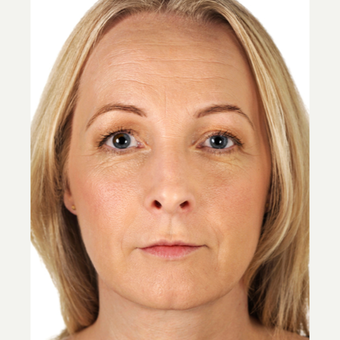 55-64 year old man treated with Restylane after 2772438