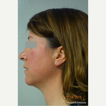 35-44 year old woman treated with Rhinoplasty before 3655636