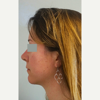 35-44 year old woman treated with Rhinoplasty after 3655636