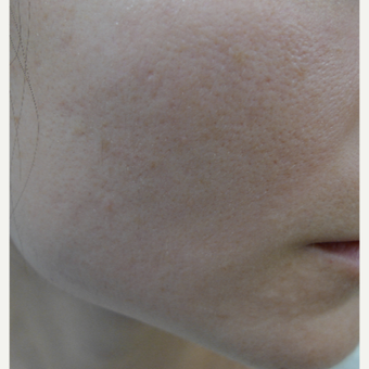 Dark acne scars treated with laser after 3084524