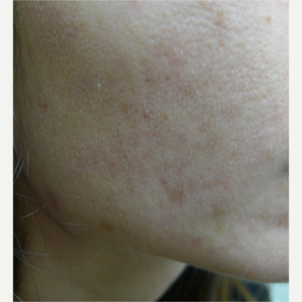 Dark acne scars treated with laser before 3084524