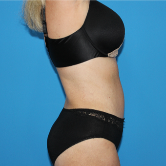 55-64 year old woman treated with Tummy Tuck after 3332942