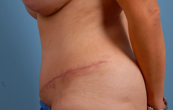 35-44 year old woman treated with Tummy Tuck after 2455974