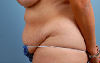 35-44 year old woman treated with Tummy Tuck before 2455974