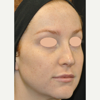 25-34 year old woman treated with Acne Treatment after 3150160