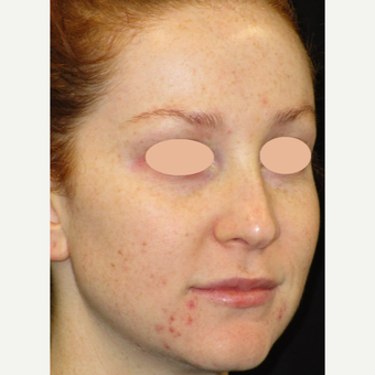 25-34 year old woman treated with Acne Treatment before 3150160