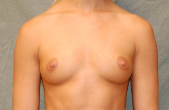 Breast Augmenation before 274552