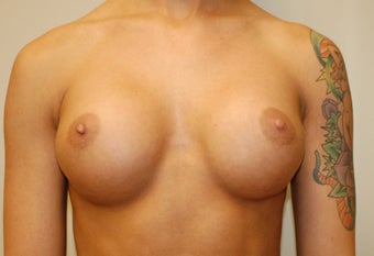 Breast Augmenation after 274552