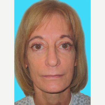 Facelift after 3826934