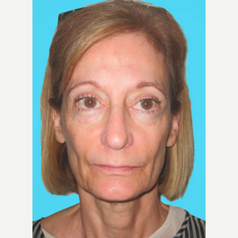 Facelift before 3826934