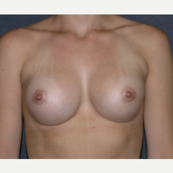 18-24 year old woman treated with Breast Implants after 3455650
