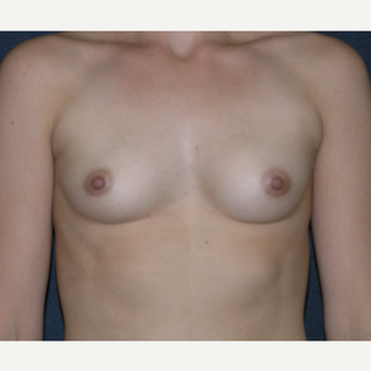 18-24 year old woman treated with Breast Implants before 3455650