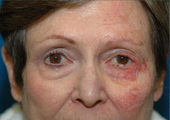 Mohs repair after excision of left lower eyelid skin cancer before 1051099