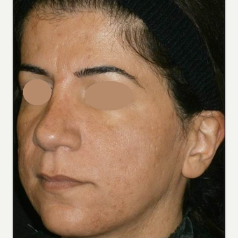 35-44 year old woman treated with ProFractional Laser after 3150286