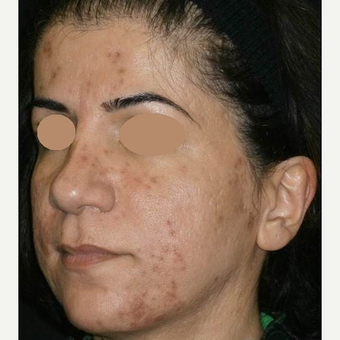 35-44 year old woman treated with ProFractional Laser before 3150286