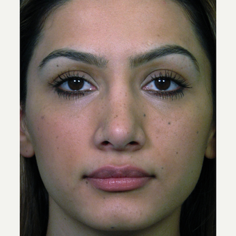 Complex revision open rhinoplasty surgery before 2857700