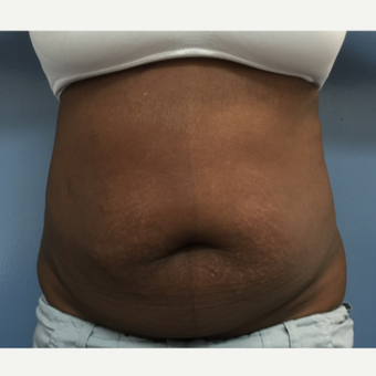 35-44 year old woman treated with Tummy Tuck and Flank Liposuction before 2993185