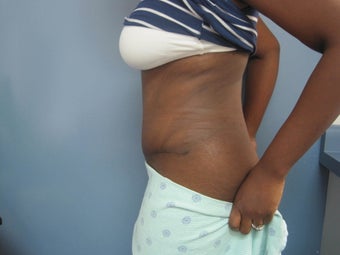 35-44 year old woman treated with Tummy Tuck and Flank Liposuction 2993185