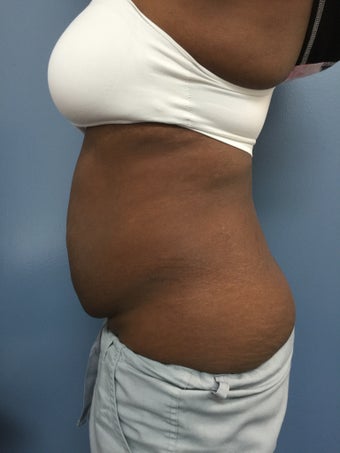 35-44 year old woman treated with Tummy Tuck and Flank Liposuction 2993185