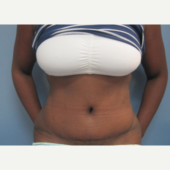 35-44 year old woman treated with Tummy Tuck and Flank Liposuction after 2993185