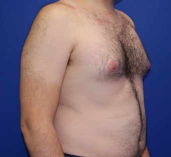 25-34 year old man treated with Laser Liposuction 3483384