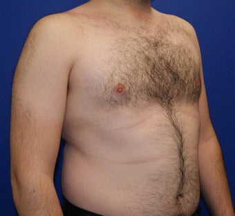 25-34 year old man treated with Laser Liposuction 3483384