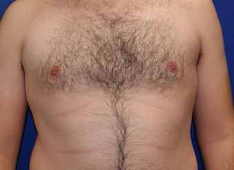25-34 year old man treated with Laser Liposuction after 3483384