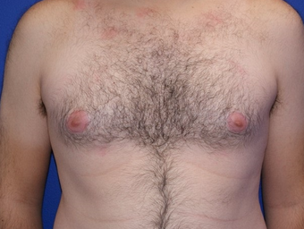 25-34 year old man treated with Laser Liposuction before 3483384