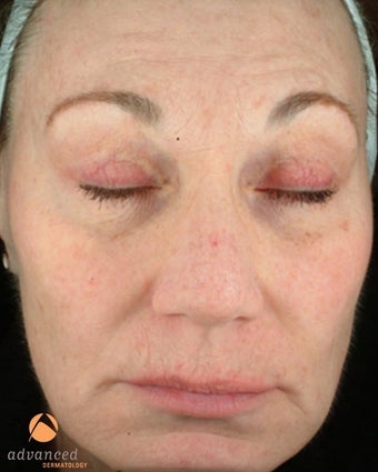 Female treated with 3 Photodynamic Therapy with Levulan for sun damage after 1041643