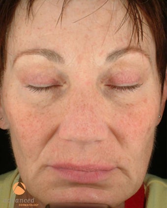 Female treated with 3 Photodynamic Therapy with Levulan for sun damage before 1041643