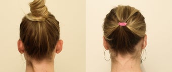 Otoplasty in a female before 1181702