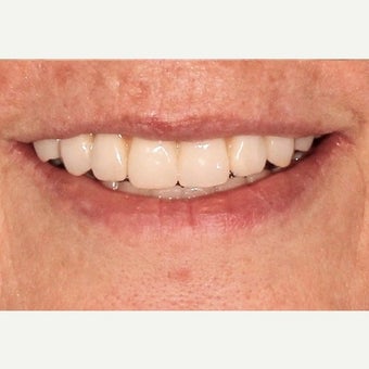 55-64 year old woman treated with All-on-4 Dental Implants after 2636724