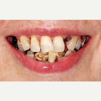 55-64 year old woman treated with All-on-4 Dental Implants before 2636724