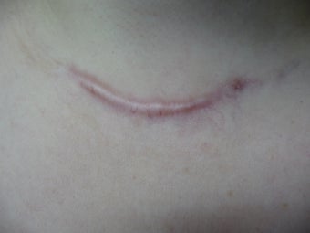 Scar Revision Procedure for Thyroid Keloid Scar on the Neck and Chest before 723190