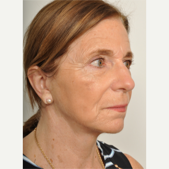 65-74 year old woman treated with Facelift after 3622403