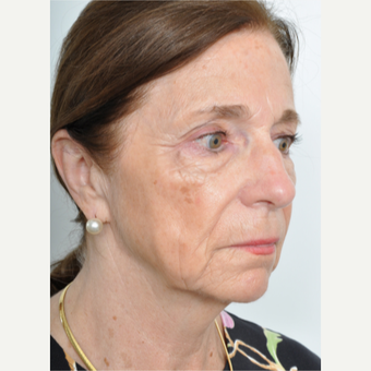 65-74 year old woman treated with Facelift before 3622403