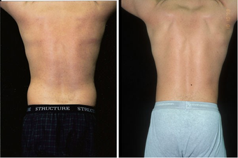31-year-old man treated with Liposuction. after 574558