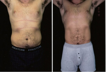 31-year-old man treated with Liposuction. before 574558