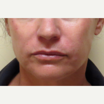 45-54 year old woman treated with Juvederm Ultra Plus in nasolabial folds after 3210808