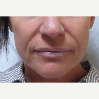 45-54 year old woman treated with Juvederm Ultra Plus in nasolabial folds before 3210808
