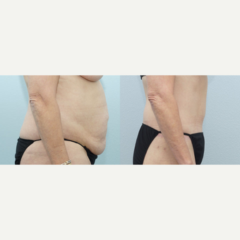 Body Lift 55 yr old Female after 3294401