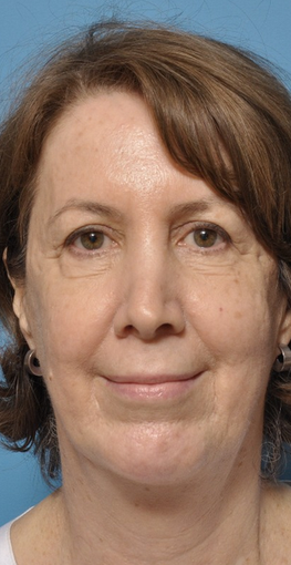 ThermiTight Neck and Jowls, Neck Liposuction, Silastic Chin Implant after 1636043