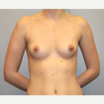Natural Breast Augmentation with Silicone implants before 3441568