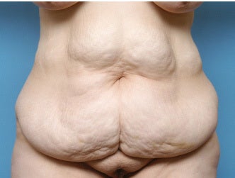 42 Year Old Female Treated For Abdominal Pannus After Weight Loss before 1118965