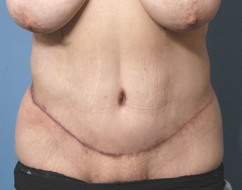42 Year Old Female Treated For Abdominal Pannus After Weight Loss after 1118965