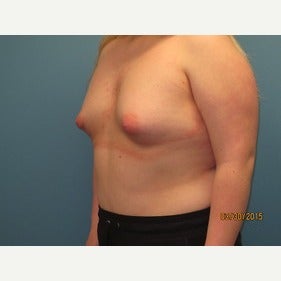 25-34 year old woman treated with MTF Breast Augmentation before 2486802