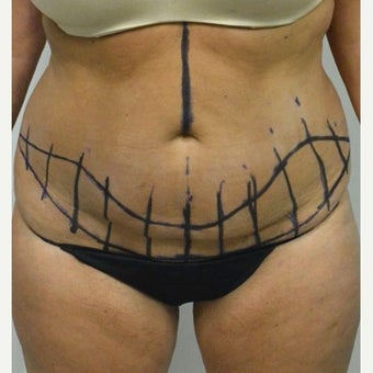 45-54 year old woman treated with Mini Tummy Tuck before 2211381