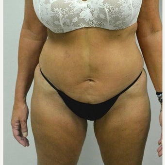 45-54 year old woman treated with Mini Tummy Tuck after 2211381